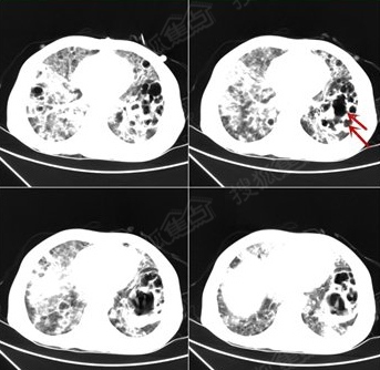肺部ct显示肺部已经被"腐蚀"出一个个空洞(如箭头所示)